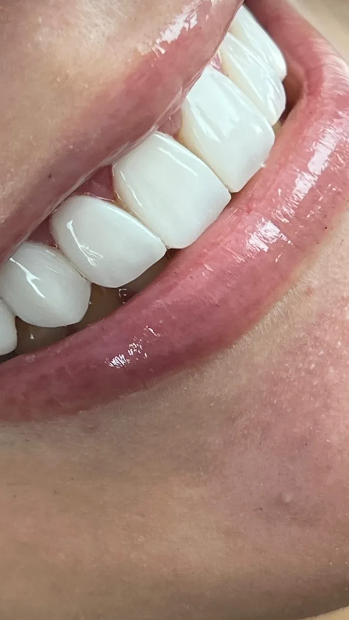 Sorriso com facetas em resina — caso 9